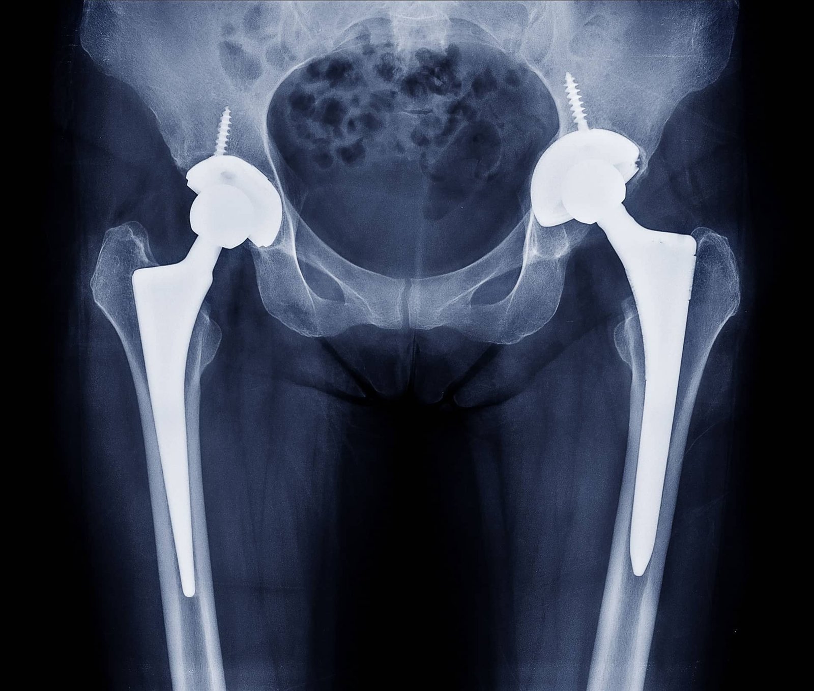 Artroplastia Total do Quadril