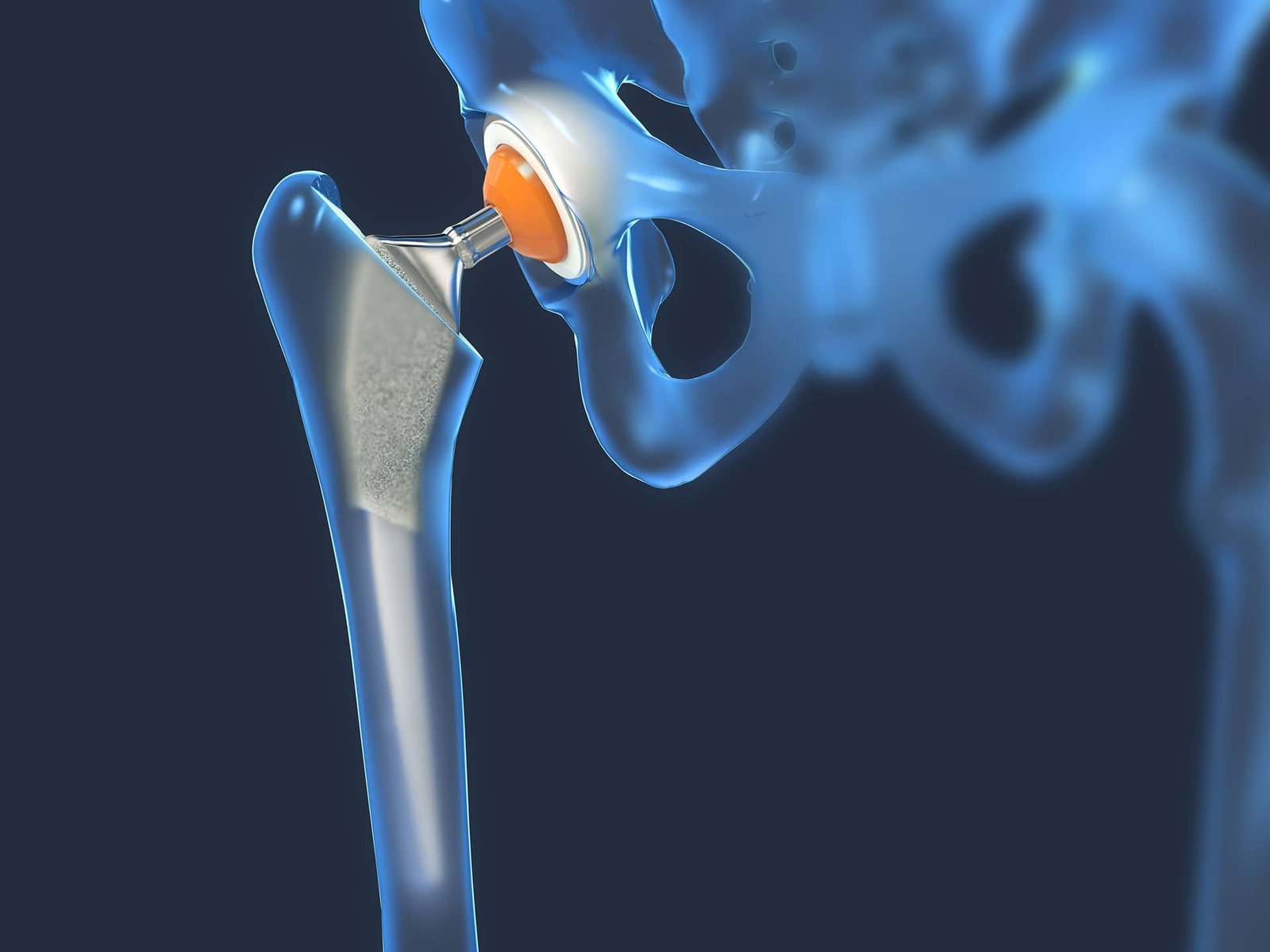 Osteonecrose da Cabeça do Fêmur