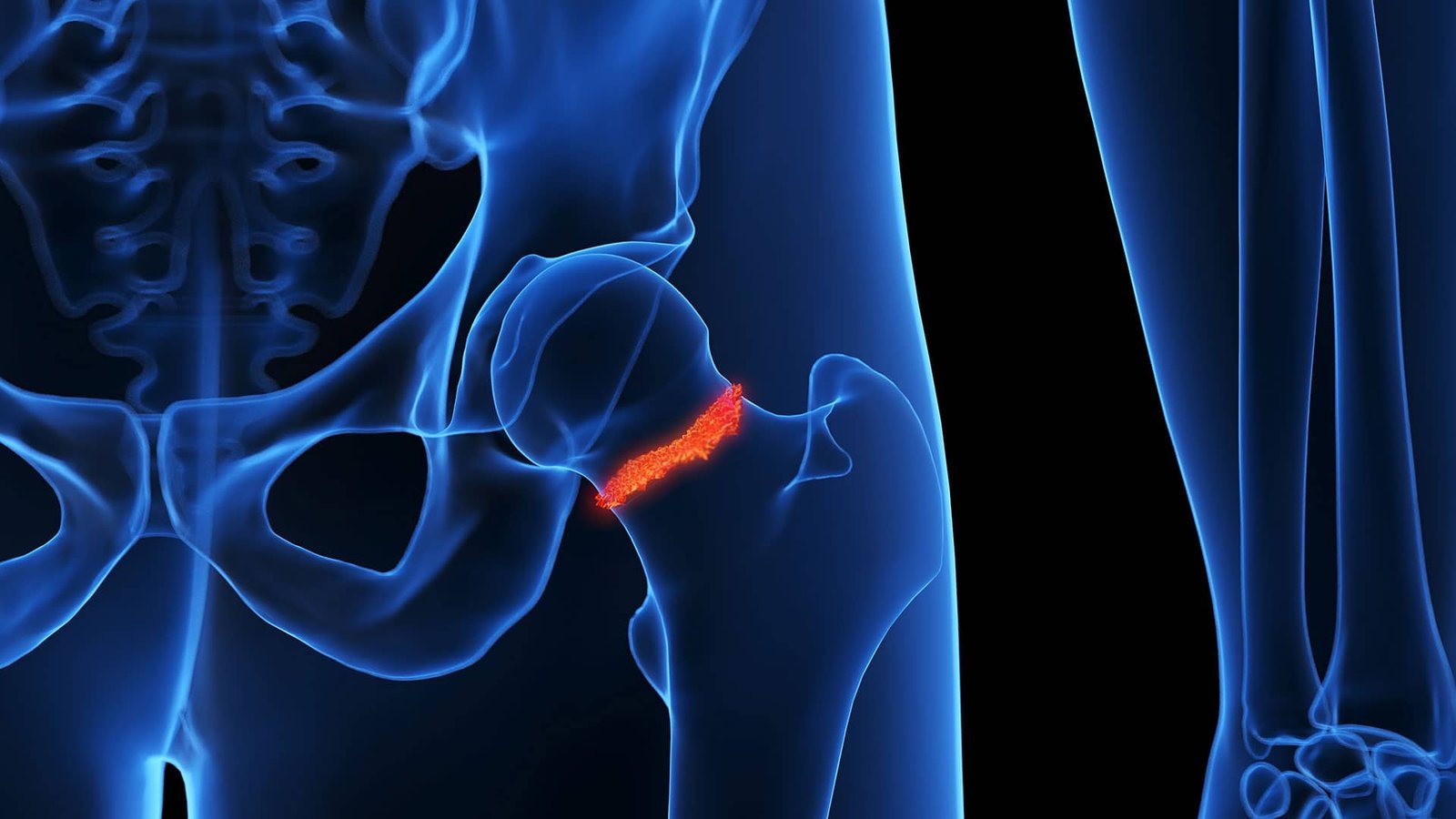 Osteossíntese de fraturas do acetábulo